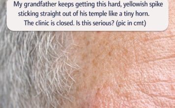 My grandfather keeps getting this hard, yellowish spike sticking straight out of his temple like a tiny horn. The clinic is closed. Is this serious?