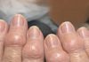 Mom is getting these thick fleshy round pads growing right over the joints on her knuckles. The nurse line is busy and she is worried. What is this?