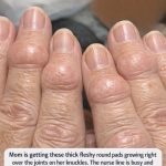 Mom is getting these thick fleshy round pads growing right over the joints on her knuckles. The nurse line is busy and she is worried. What is this?