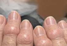 Mom is getting these thick fleshy round pads growing right over the joints on her knuckles. The nurse line is busy and she is worried. What is this?