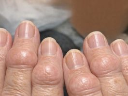 Mom is getting these thick fleshy round pads growing right over the joints on her knuckles. The nurse line is busy and she is worried. What is this?