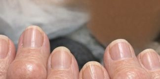 Mom is getting these thick fleshy round pads growing right over the joints on her knuckles. The nurse line is busy and she is worried. What is this?