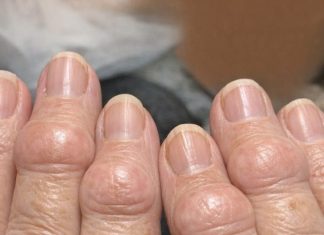 Mom is getting these thick fleshy round pads growing right over the joints on her knuckles. The nurse line is busy and she is worried. What is this?