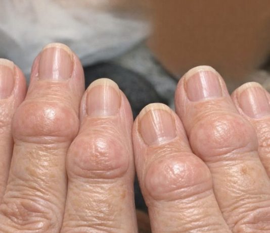 Mom is getting these thick fleshy round pads growing right over the joints on her knuckles. The nurse line is busy and she is worried. What is this?